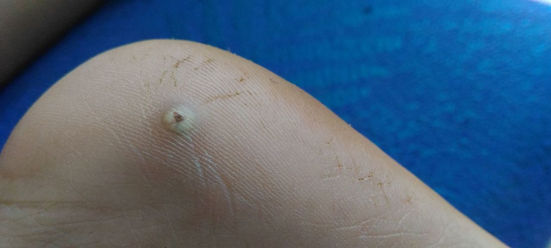 Bicho de pé (Tungíase): Guia Completo de Prevenção, Diagnóstico e Tratamento - Imagem do artigo